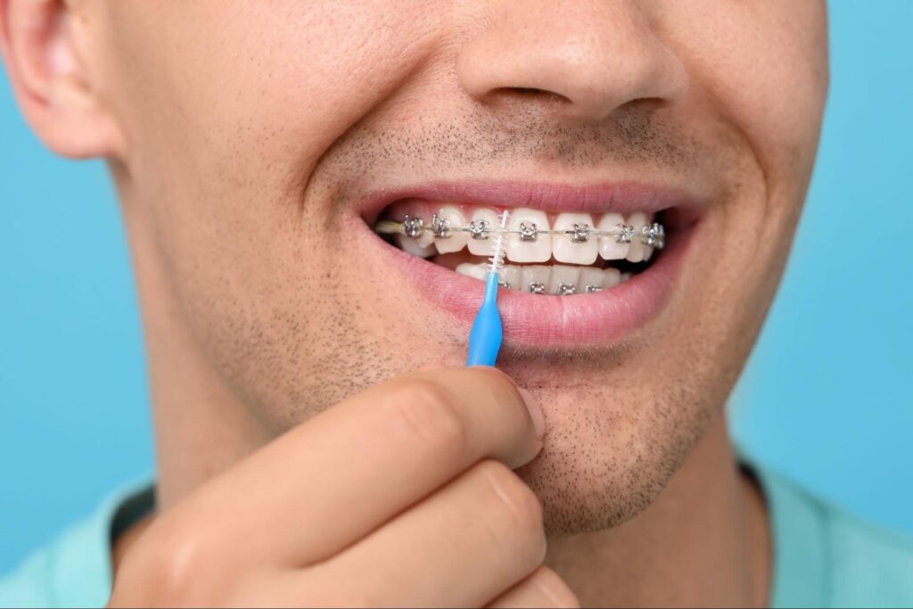 Smart After Braces Care for a Smile That Lasts